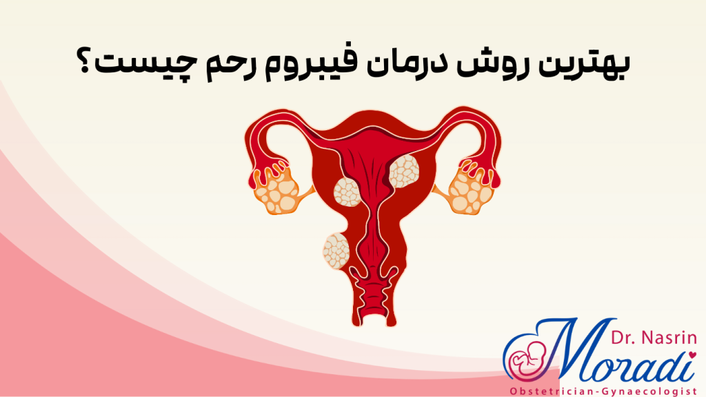 بهترین روش درمان فیبروم رحم