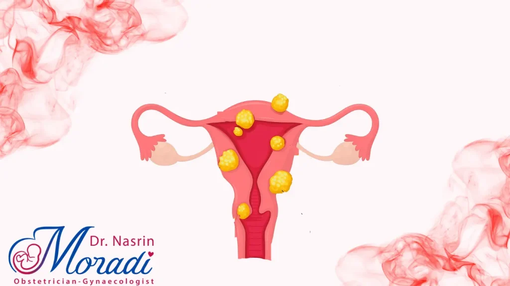 جراحی میومکتومی
