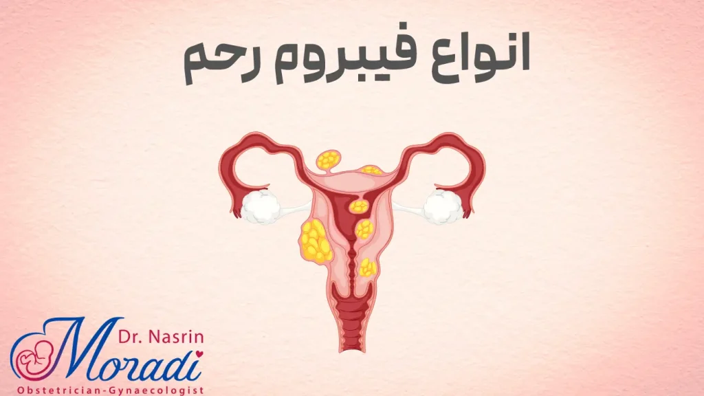 انواع فیبرومهای رحم