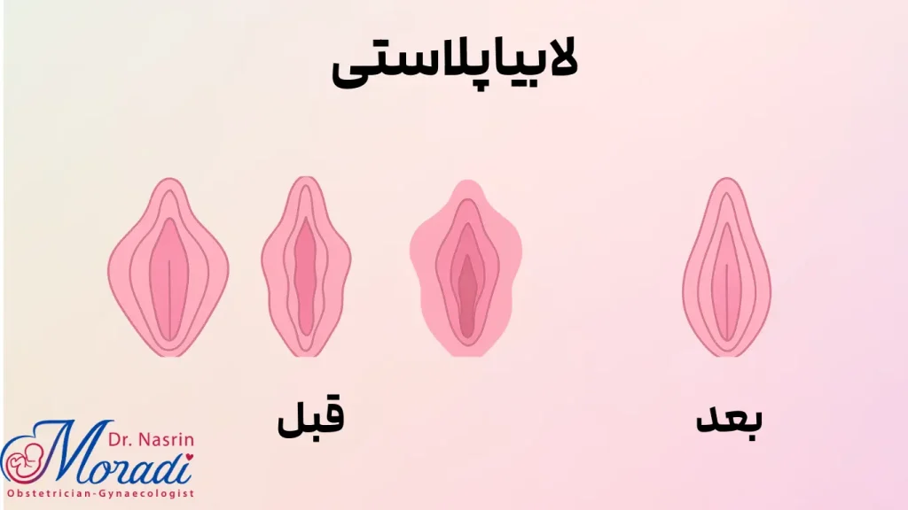 لابیاپلاستی