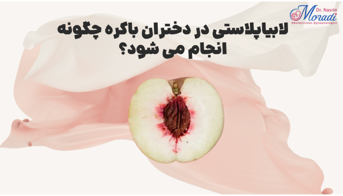 لابیاپلاستی در دختران باکره چگونه انجام می شود؟
