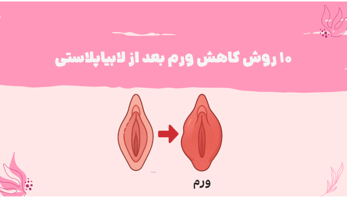 10 روش کاهش ورم بعد از لابیاپلاستی
