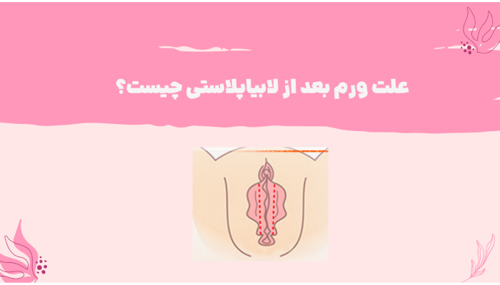 علت ورم بعد از لابیاپلاستی چیست؟